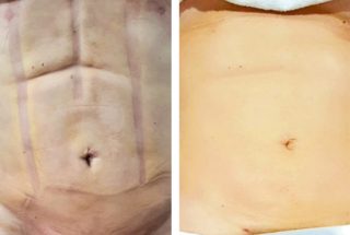 Tratamento de Fibrose Pós-Lipo em São Paulo